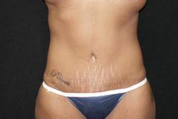 Postop Front